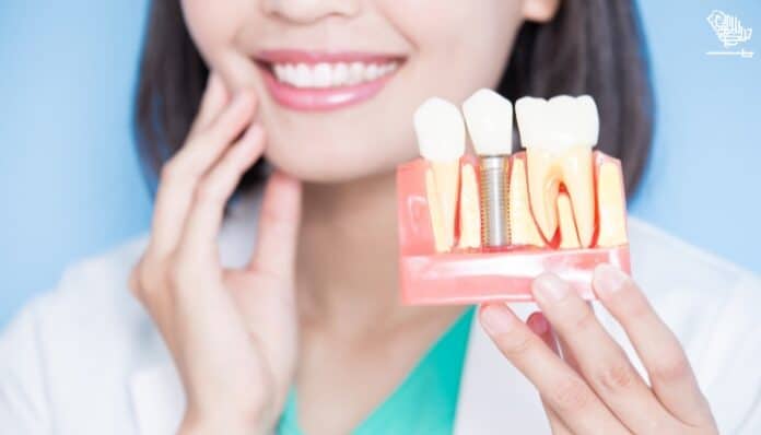 Dental Implants – A Comprehensive Guide